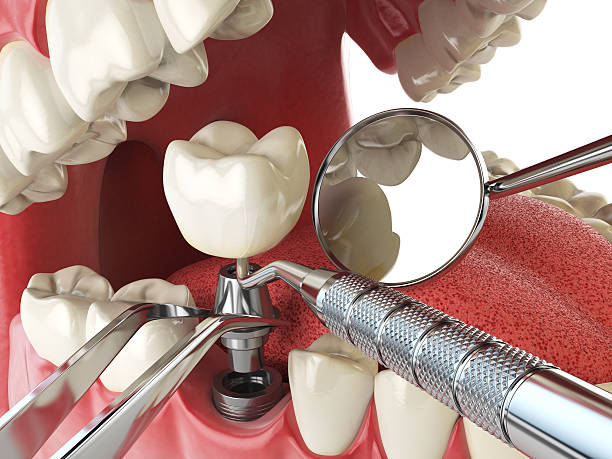 Best Emergency Tooth Extraction in Garden City, SC